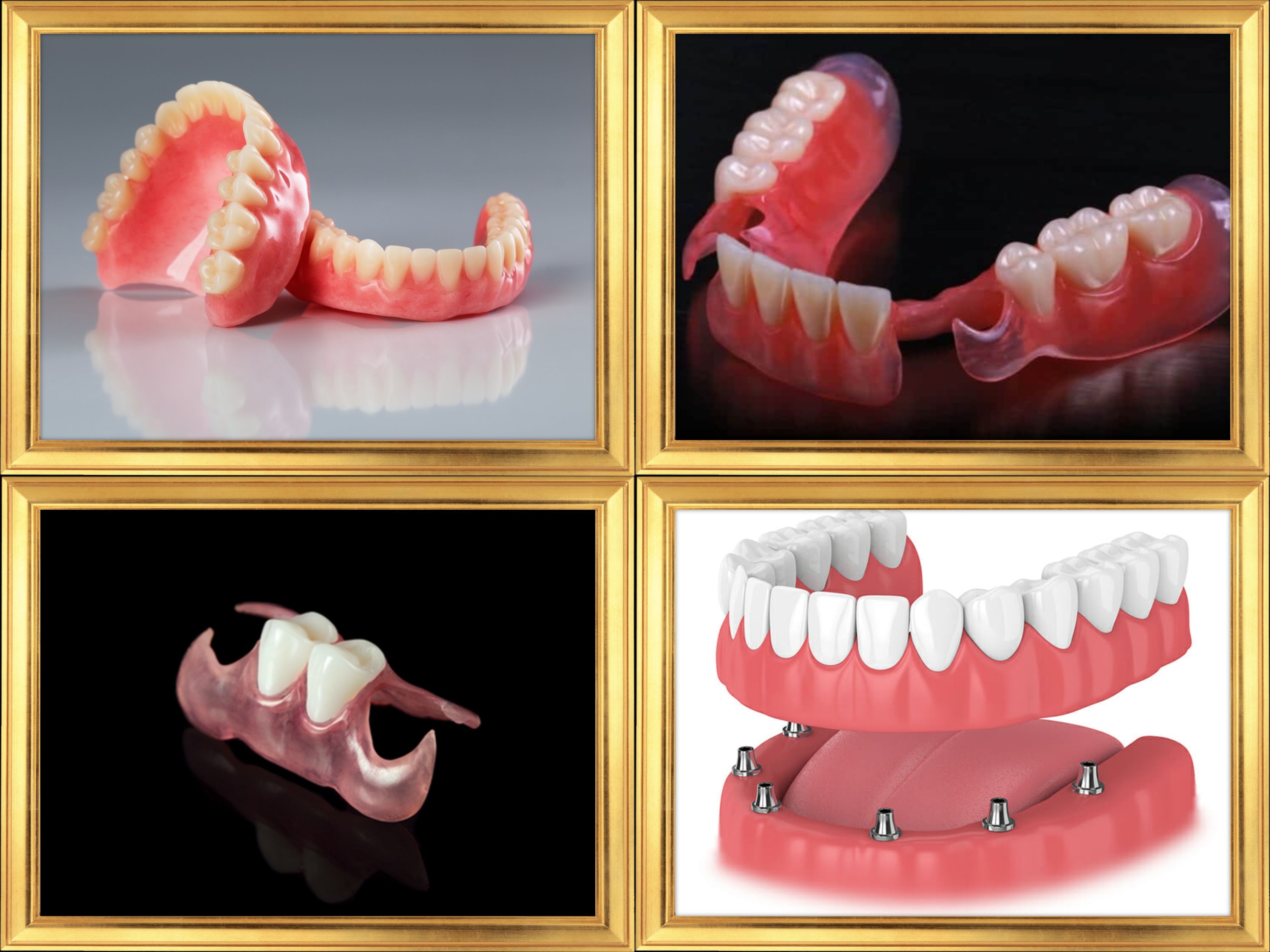 Dental Dentures, Complete Denture, Removable Partial Denture